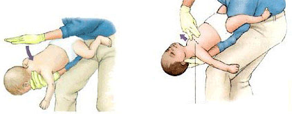 영아기도폐쇄에 대한 이미지